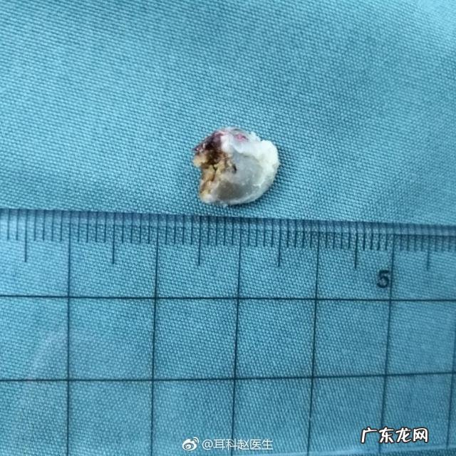 脂肪瘤是怎么长出来的，它会变成癌症吗？