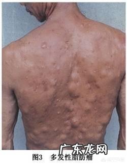 脂肪瘤是怎么长出来的，它会变成癌症吗？