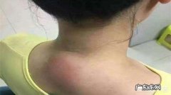 做什么运动可以把脖子后面的“富贵包”去掉？