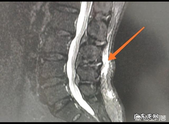 右后背上侧有时疼,不咳嗽,大夫为什么要查心电图?