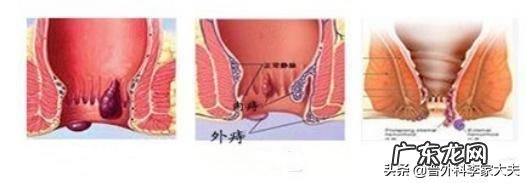 请问专家,路走多了痔疮会发吗