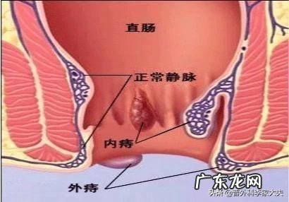 请问专家,路走多了痔疮会发吗