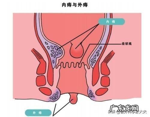请问专家,路走多了痔疮会发吗