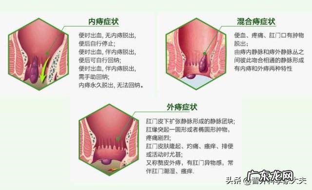 请问专家,路走多了痔疮会发吗