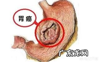 得了幽门螺杆菌就会患胃癌吗