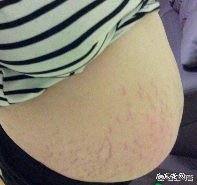 怀孕多久以后开始祛除妊娠纹比较好?有哪些需要注意的问题?