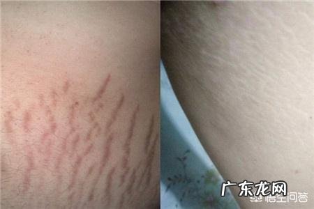 怀孕多久以后开始祛除妊娠纹比较好?有哪些需要注意的问题?