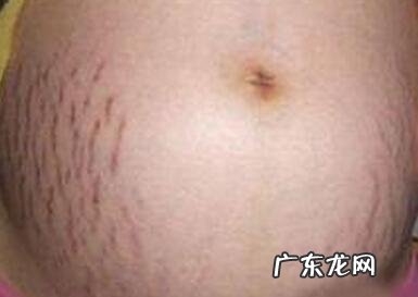怀孕多久以后开始祛除妊娠纹比较好?有哪些需要注意的问题?