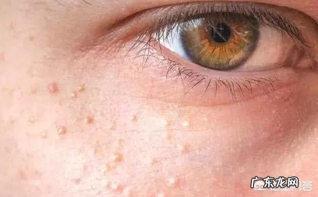 身上长脂肪瘤到处都是怎么回事 老是长脂肪瘤是什么原因?