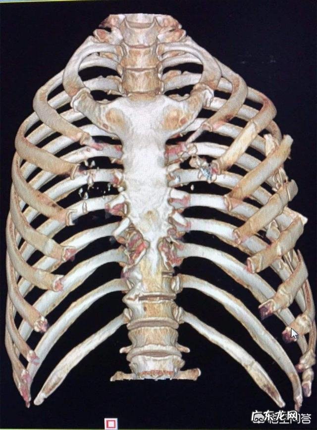 第五、六根肋骨骨折了,需要如何休养才能好的比较快?