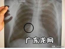 肋骨骨折多久不疼?能上下床不疼?