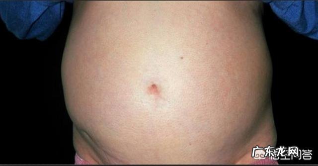 肝硬化患者,最近身体出现很多小疙瘩,该怎么办?