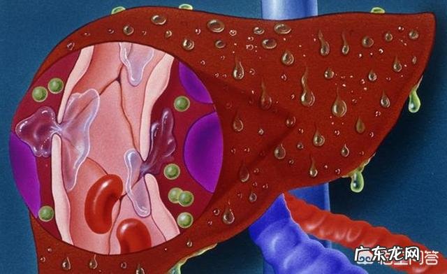 肝硬化患者,最近身体出现很多小疙瘩,该怎么办?