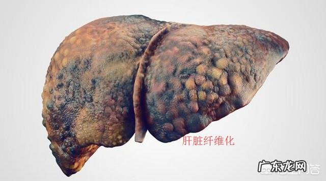 肝硬化患者,最近身体出现很多小疙瘩,该怎么办?