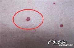 肝硬化患者，最近身体出现很多小疙瘩，该怎么办？