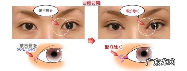 如何按摩眼睛变大 眼头切开风按摩