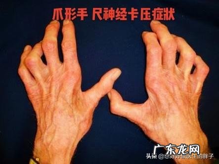 手麻手指发烫怎么回事 手麻、手指疼是怎么回事？