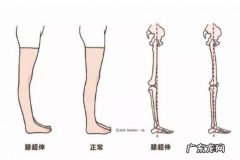 膝盖超伸怎么矫正 如何正确处理膝超伸