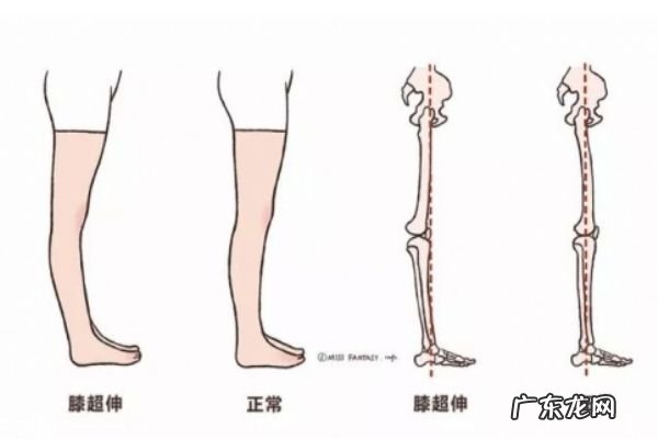 膝盖超伸怎么矫正 如何正确处理膝超伸