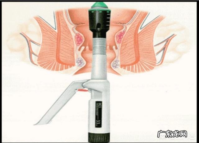 有内痔的人该如何避免自己的痔疮复发