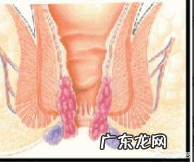 有内痔的人该如何避免自己的痔疮复发