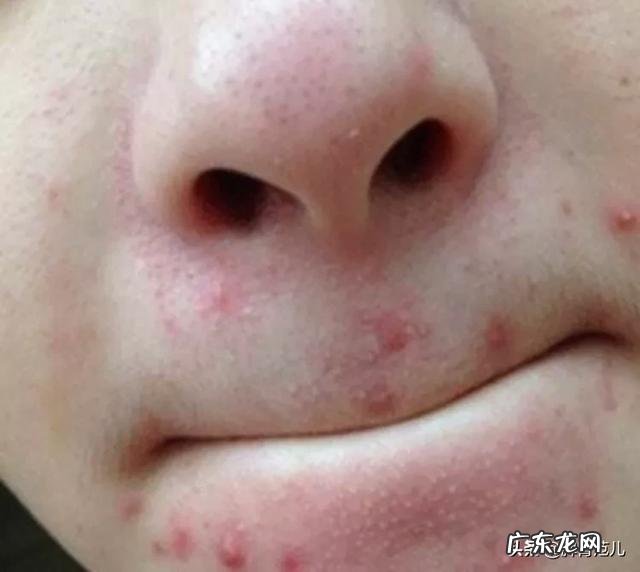 湿气重的人一定会有齿痕舌吗