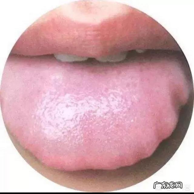 湿气重的人一定会有齿痕舌吗