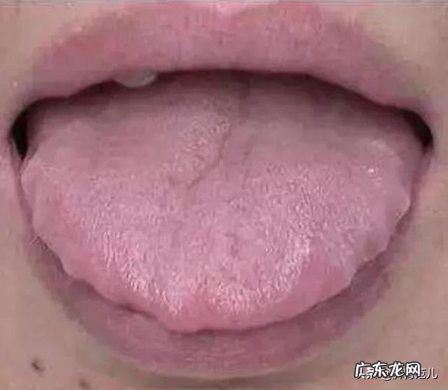 湿气重的人一定会有齿痕舌吗