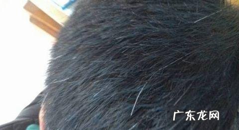 焦虑会长白头发吗 白头发如何预防