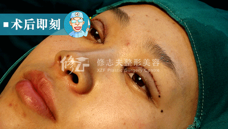 刀口长肉芽是怎么回事 割双服皮后出现肉条是怎么回事？