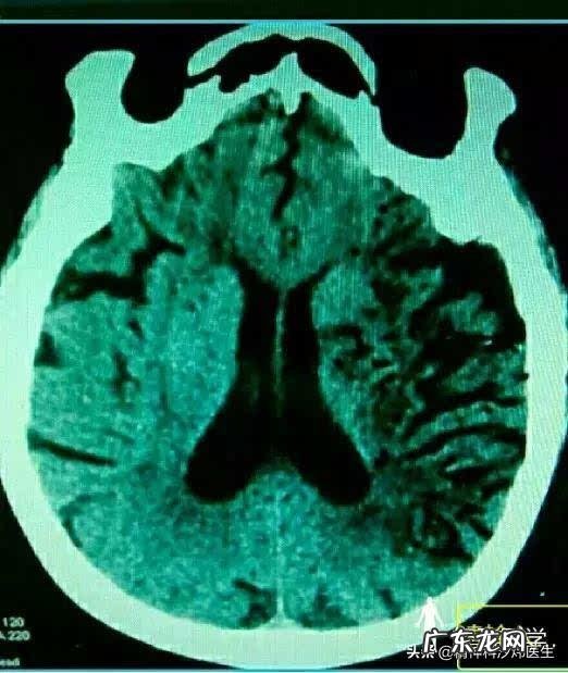 怎么让病情暂时稳定的精神分裂症患者认识到吃药的重要性？