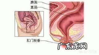 宝妈坐月子时得了痔疮,擦什么药比较好