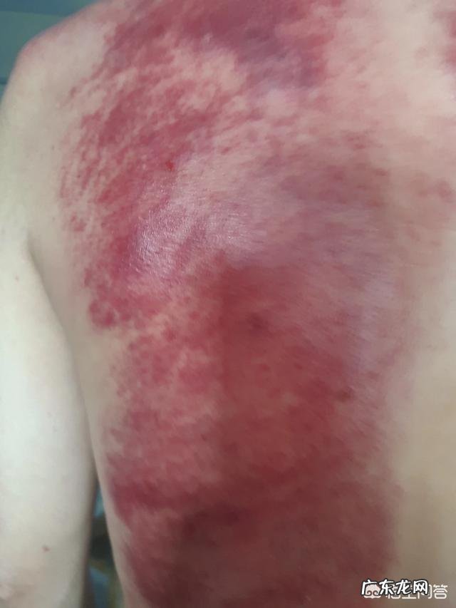 拔火罐和刮痧有什么区别？