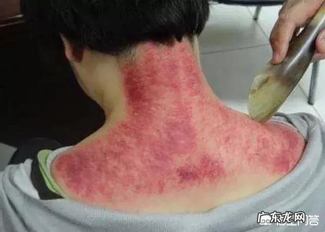 拔火罐和刮痧有什么区别？