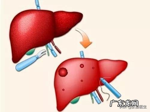 请问:多发性肝囊肿严重吗,需要注意什么