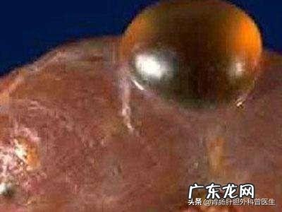 请问:多发性肝囊肿严重吗,需要注意什么