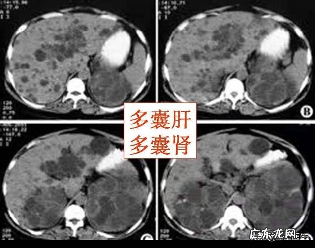 请问：多发性肝囊肿严重吗，需要注意什么