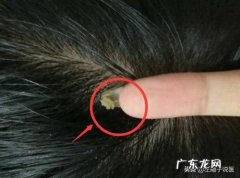 医生说从头皮抠出“白泥”，说明是有头皮螨虫，这是真的吗