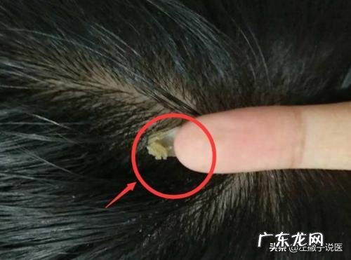 医生说从头皮抠出“白泥”,说明是有头皮螨虫,这是真的吗