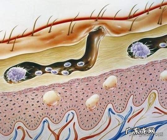 医生说从头皮抠出“白泥”,说明是有头皮螨虫,这是真的吗