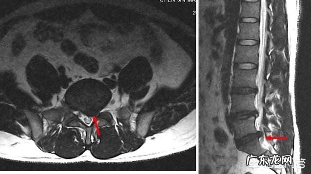 每次拉完引体向上后右胳膊关节疼，为什么