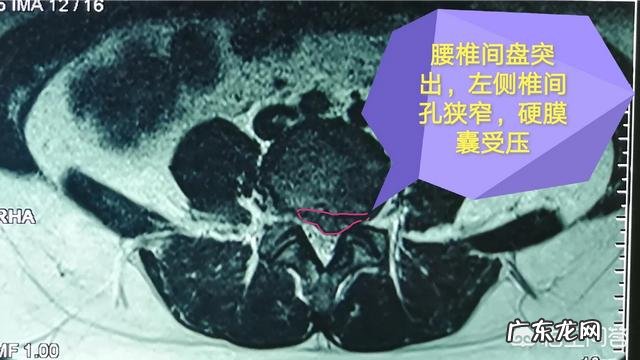 腰椎间盘膨出,腰不疼一侧屁股疼,疼得走不了路有什么好办法?