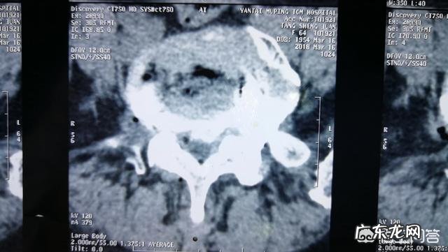 腰椎间盘膨出,腰不疼一侧屁股疼,疼得走不了路有什么好办法?