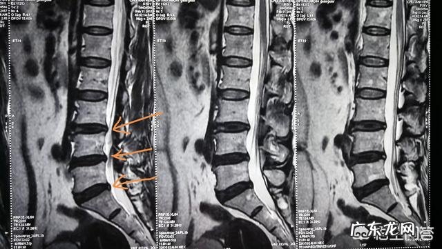 腰椎间盘膨出,腰不疼一侧屁股疼,疼得走不了路有什么好办法?