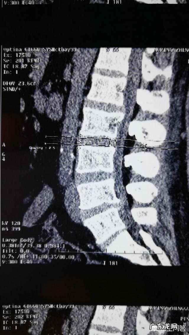 腰椎间盘膨出,腰不疼一侧屁股疼,疼得走不了路有什么好办法?