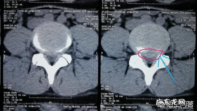 腰椎间盘膨出,腰不疼一侧屁股疼,疼得走不了路有什么好办法?