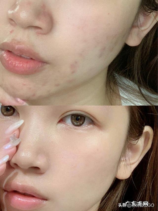 拼多多上有那些性价比高的祛痘产品?