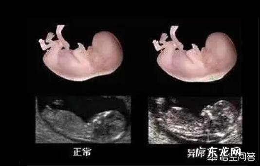 孕妈的diyi次产前筛查很重要,为啥要做NT筛查何时做NT筛查