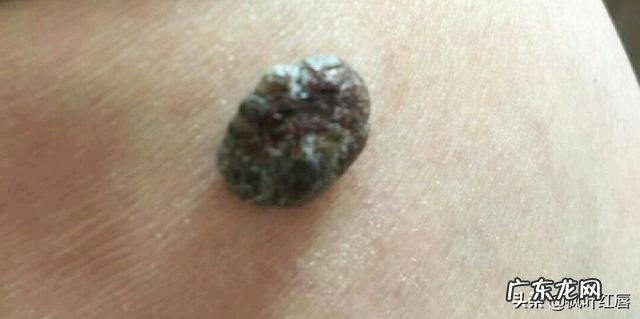 人身体上有痣的地方大多会长体毛为什么