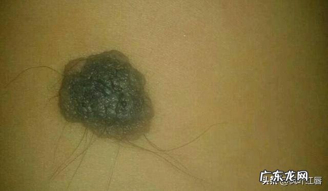 人身体上有痣的地方大多会长体毛为什么